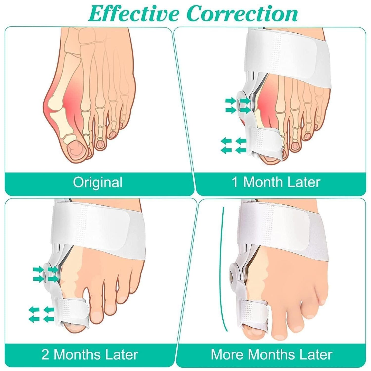 Silicone Toe Separator for Adults – Bunion Corrector & Toe Alignment Kit | NISHU Superstores