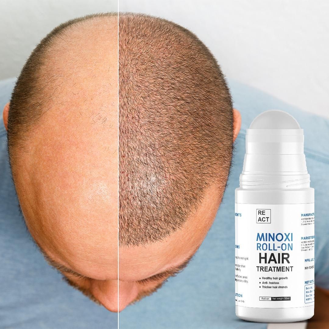 Minoxi Roll-On Hair Growth Serum for Men & Women – NISHU Superstores
