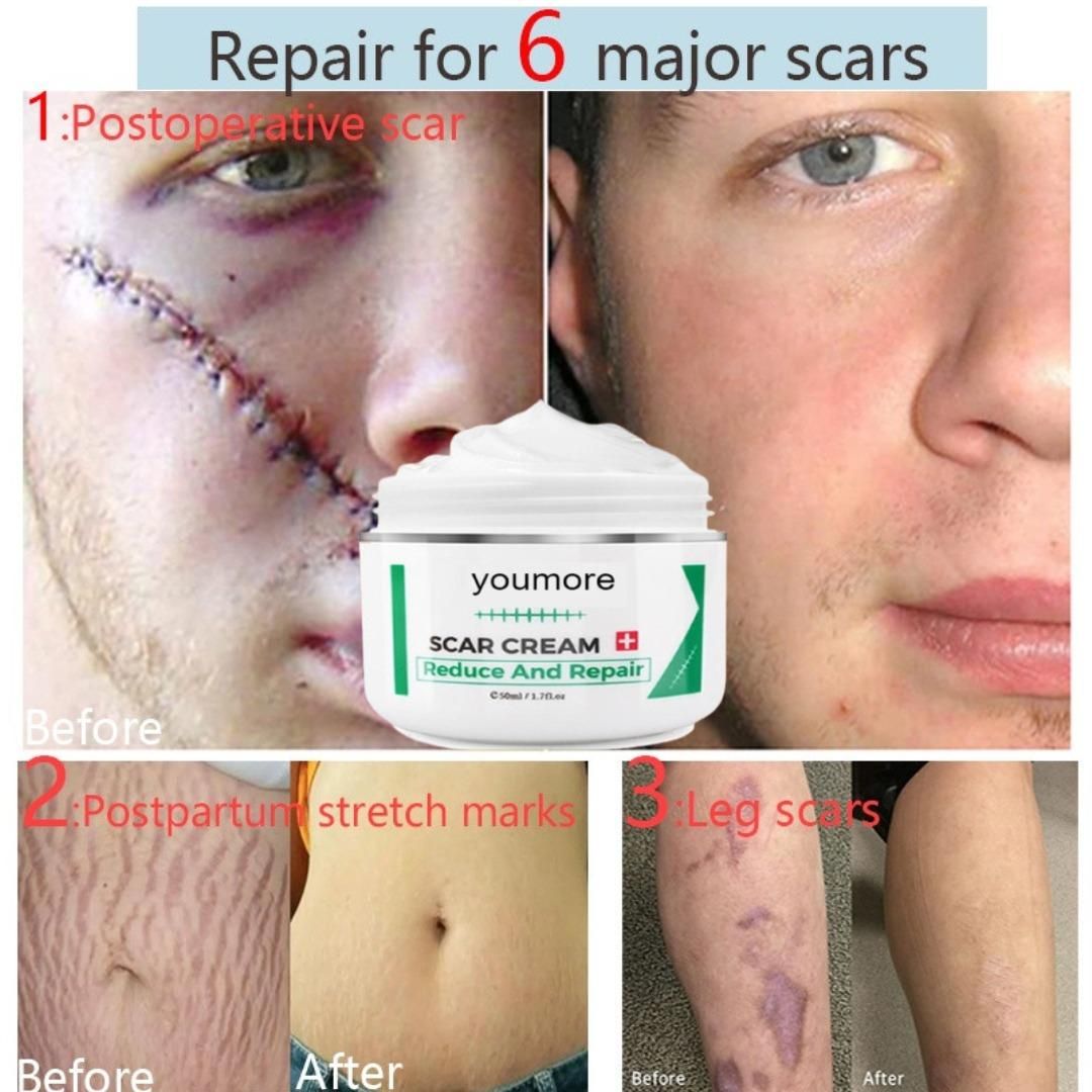 Scar Remover Stretch Mark Cream 50gm – Fade Scars & Stretch Marks Naturally | NISHU Superstores