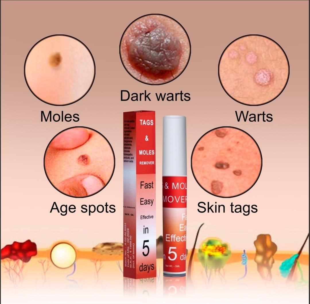 Skin Tags & Moles Remover – Pain-Free Treatment at Home | NISHU Superstores