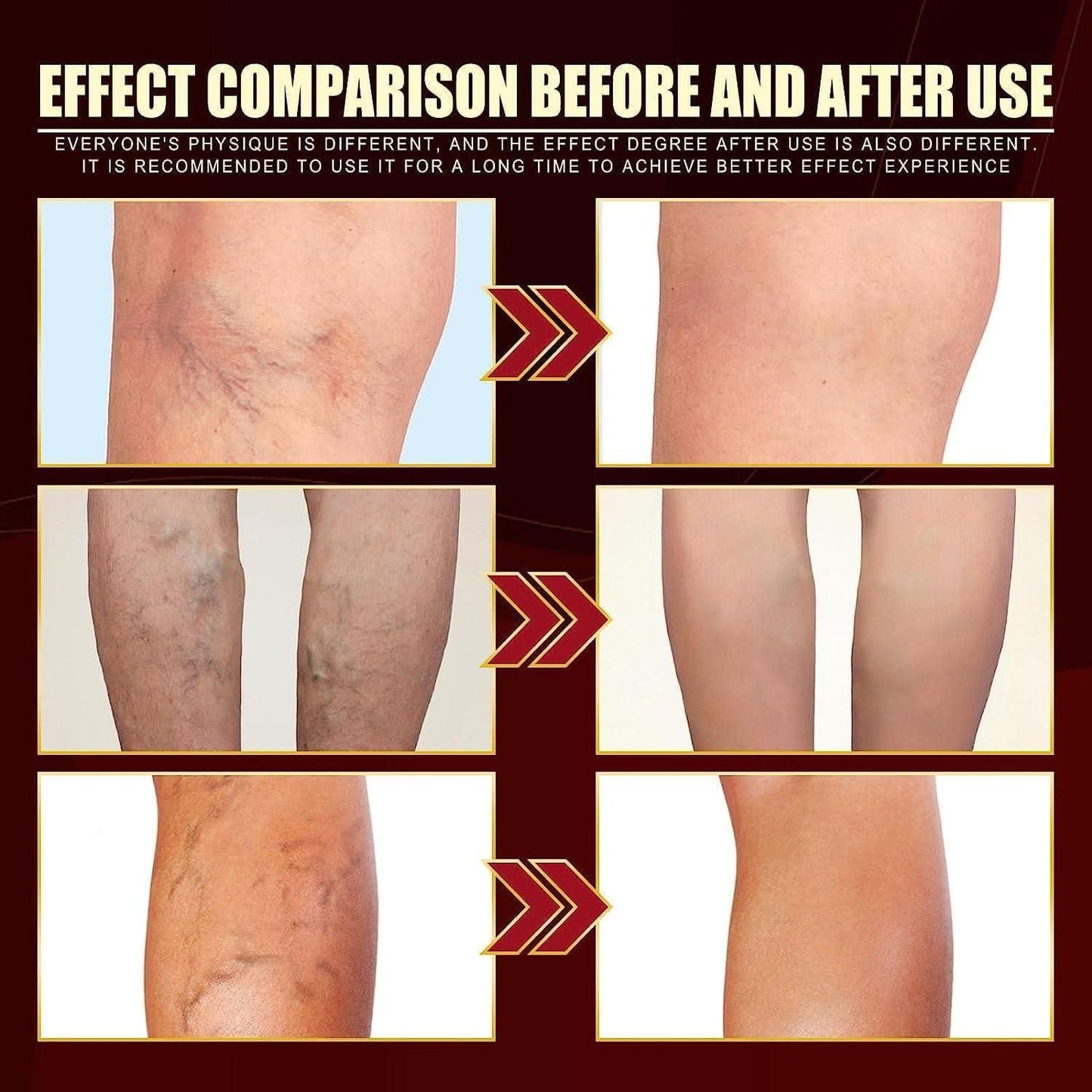 Vein Healing Varicose Veins Treatment Spray – Fast Relief for Leg Pain & Swelling | Pack of 1 | NISHU Superstores