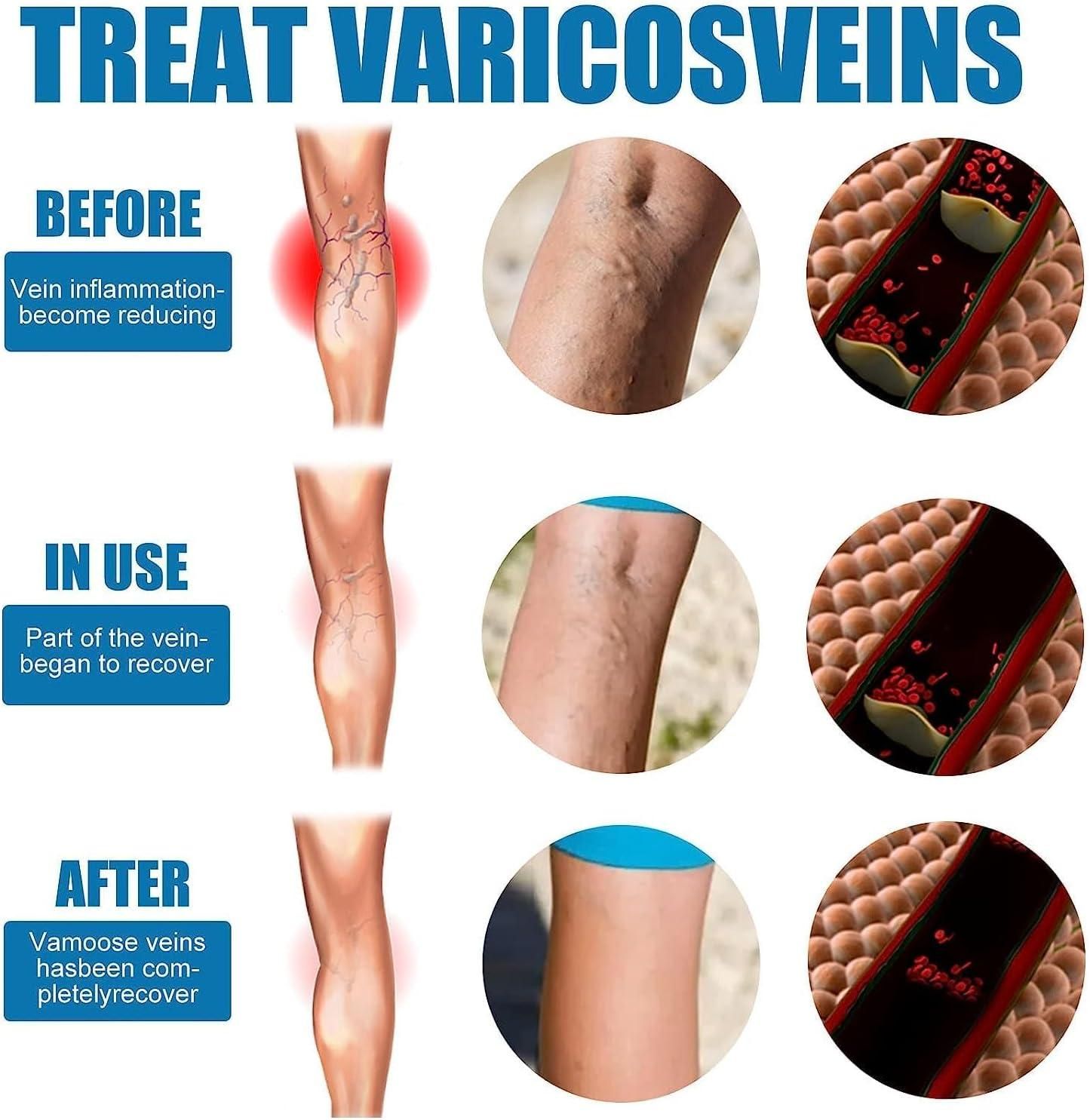 Vein Healing Varicose Veins Treatment Spray – Fast Relief for Leg Pain & Swelling | Pack of 1 | NISHU Superstores