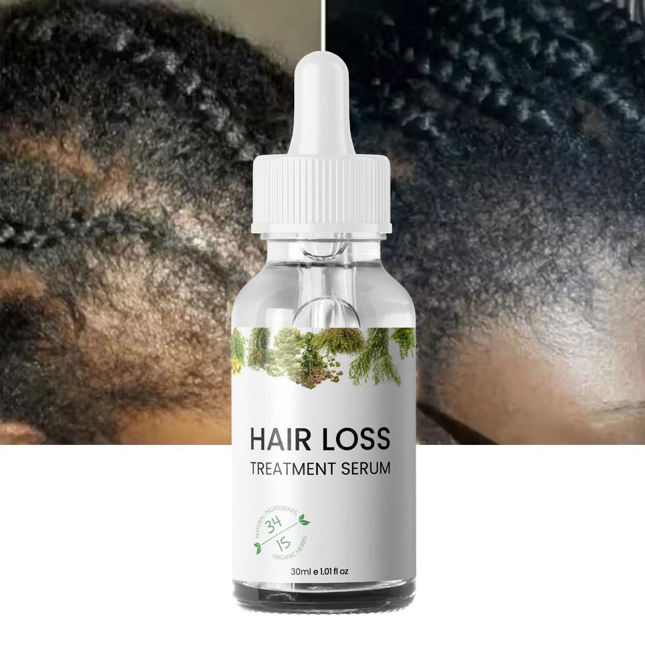 Hair Loss Treatment Serum 30ml (Pack of 2) – Boost Hair Growth & Strengthen Roots | NISHU Superstores