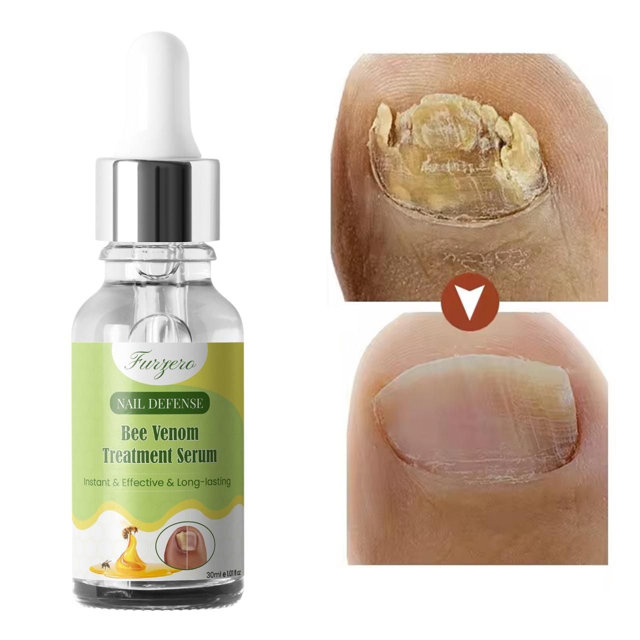 Furgero Nail Defense Bee Venom Serum 30ml – Anti-Fungal Nail Treatment | NISHU Superstores