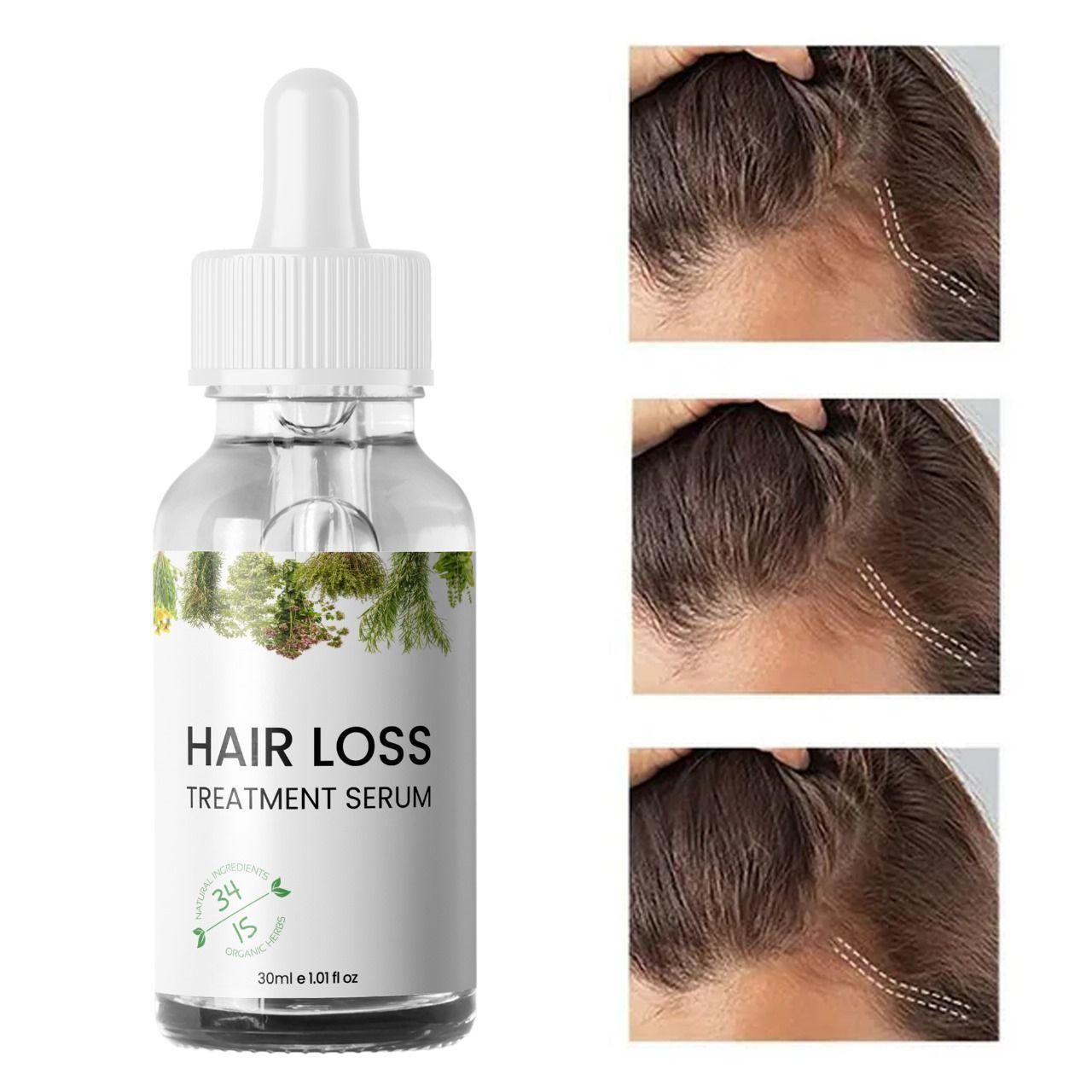 Hair Loss Treatment Serum 30ml (Pack of 2) – Boost Hair Growth & Strengthen Roots | NISHU Superstores