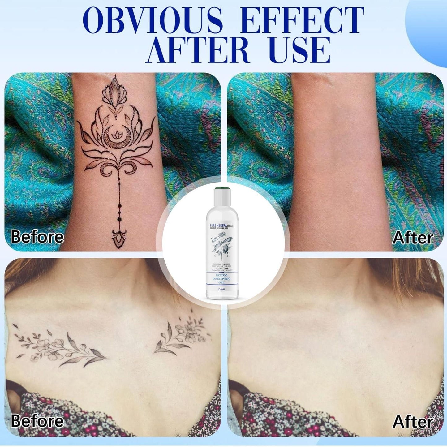 Tattoo Dissolving Gel 100ML (Pack of 2) – Effective & Safe Tattoo Removal | NISHU Superstores