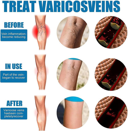 Vein Healing Varicose Veins Treatment Spray – Fast Relief for Leg Pain & Swelling | Pack of 1 | NISHU Superstores