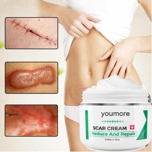 Scar Remover Stretch Mark Cream 50gm – Fade Scars & Stretch Marks Naturally | NISHU Superstores